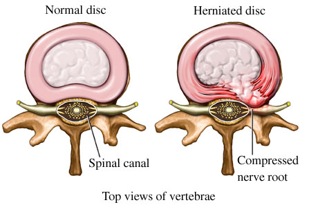 نوار عصب و عضله و تشخیص دیسک کمر