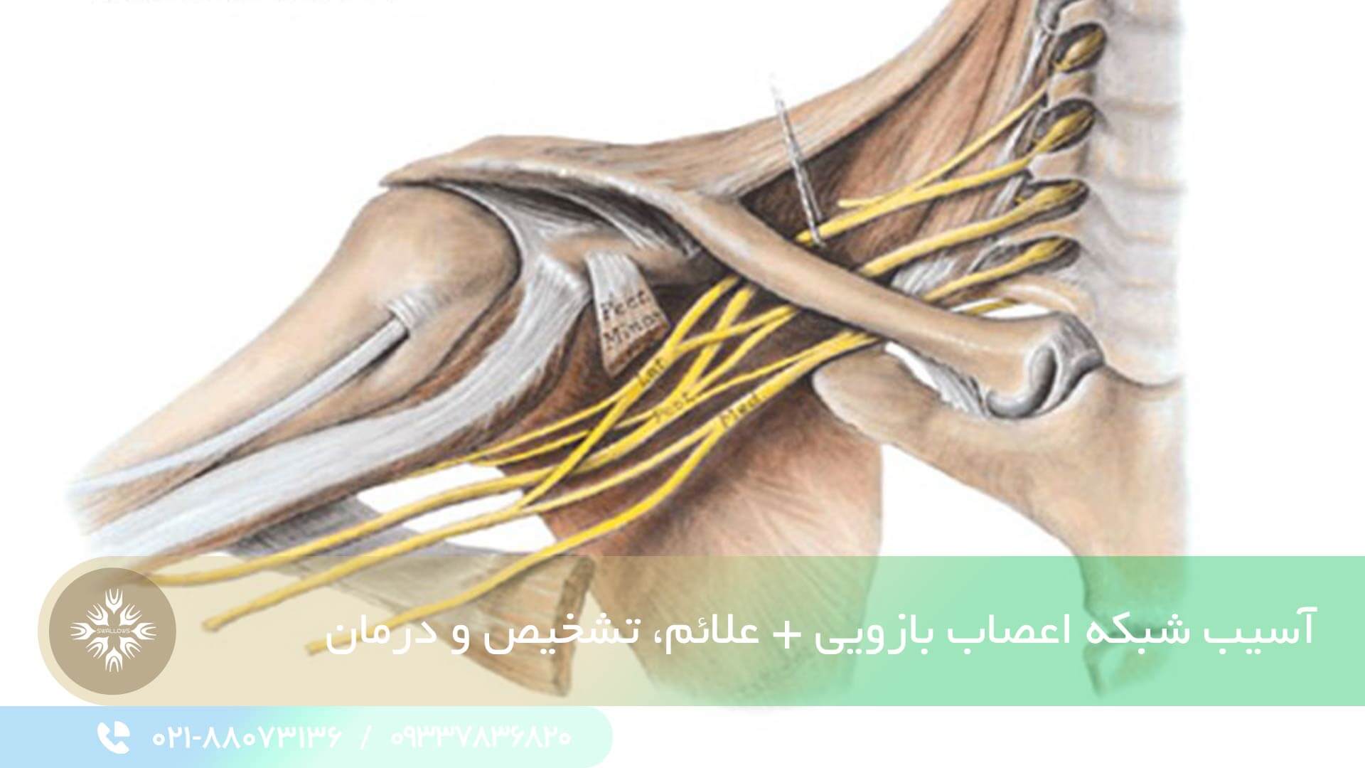آسیب شبکه اعصاب بازویی
