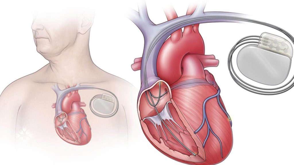 درمان همزمان سازی مجدد قلبی چیست