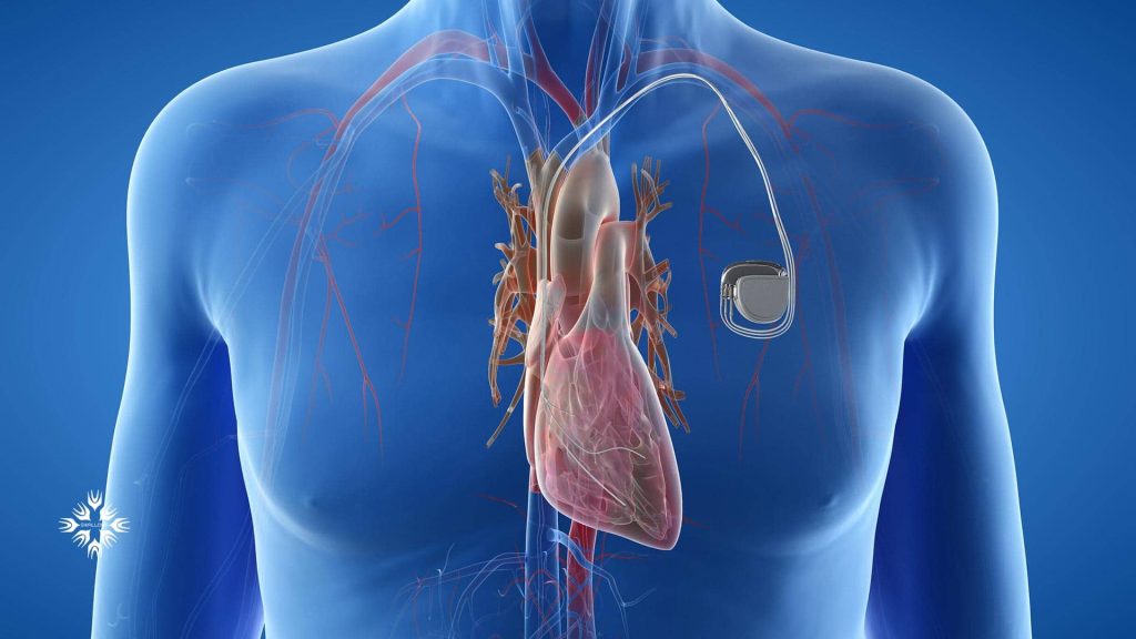 دستگاه تنظیم کننده ضربان قلب یا ضربان ساز