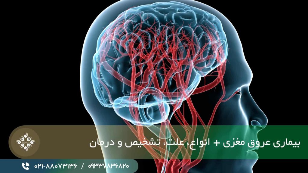 بیماری عروق مغزی چیست