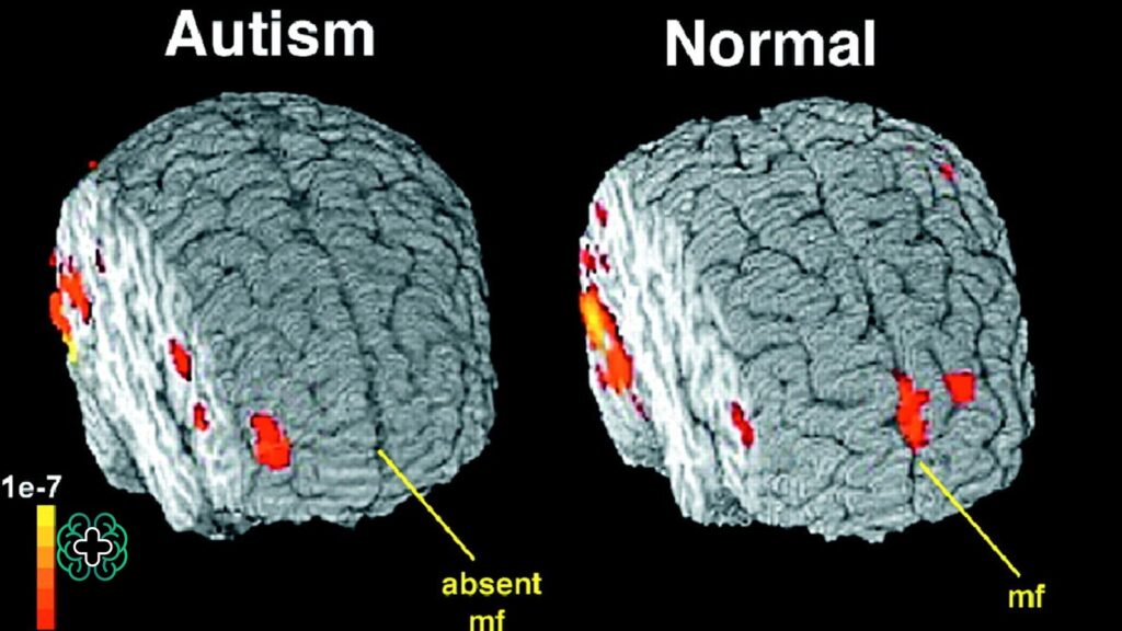 آیا انجام نوار مغز برای تشخیص اوتیسم ضروری است
