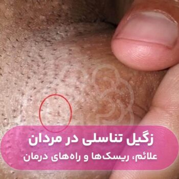 علت به وجود آمدن زگیل تناسلی در مردان چیست