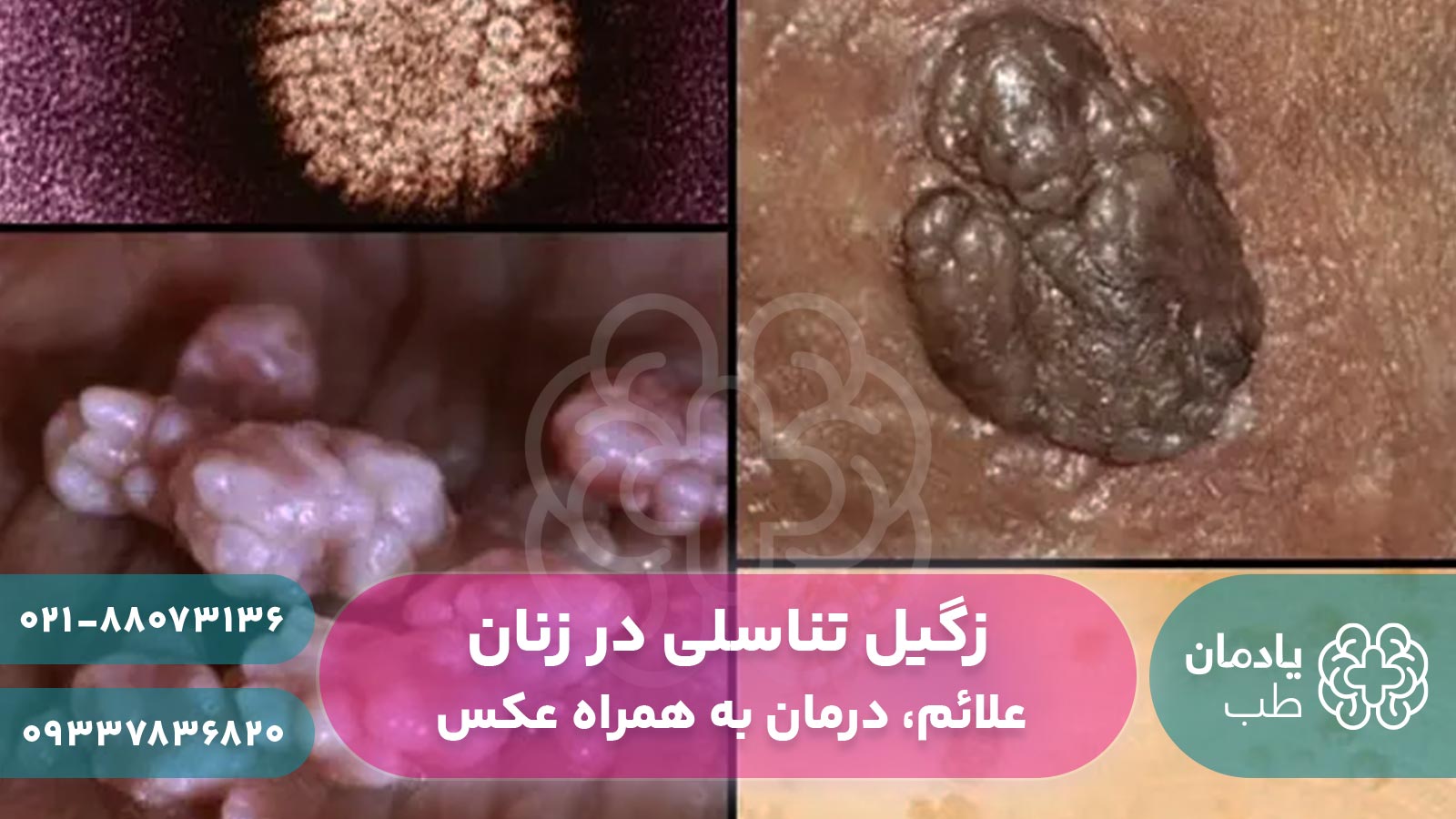 زگیل تناسلی در زنان چیست به همراه عکس