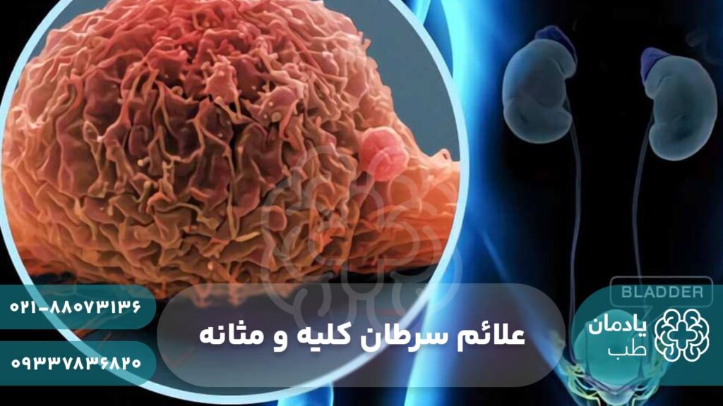 علائم سرطان کیه و مثانه چیست