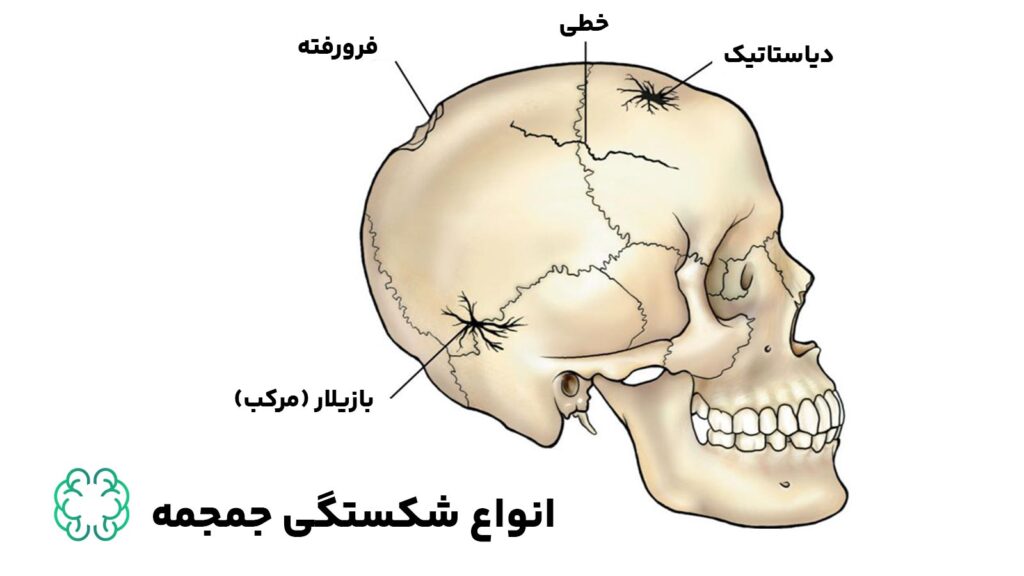 انواع شکستگی جمجمه - آسیب ترومای سر