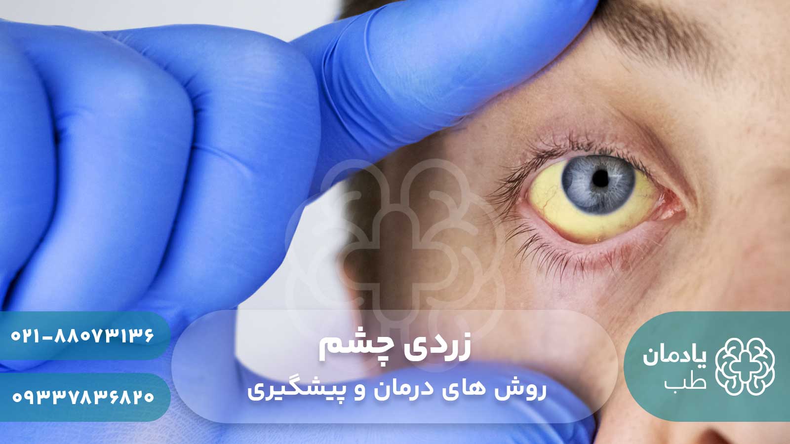 روش های درمان زردی چشم + پیشگیری