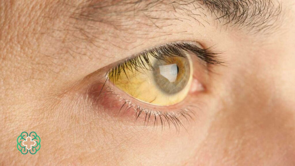 درمان زردی چشم در بزرگسالان