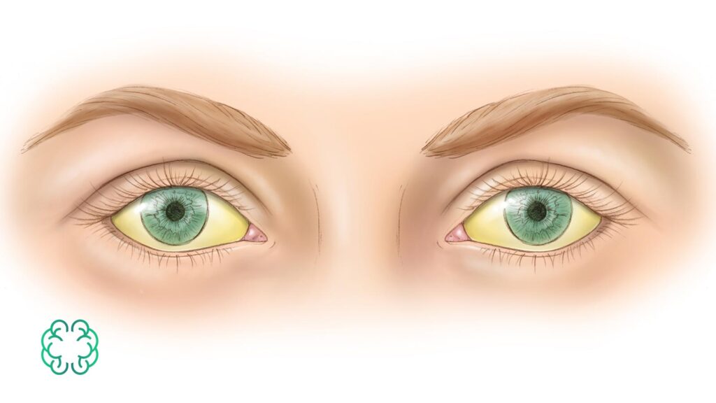 زردی چشم چیست و درمان آن